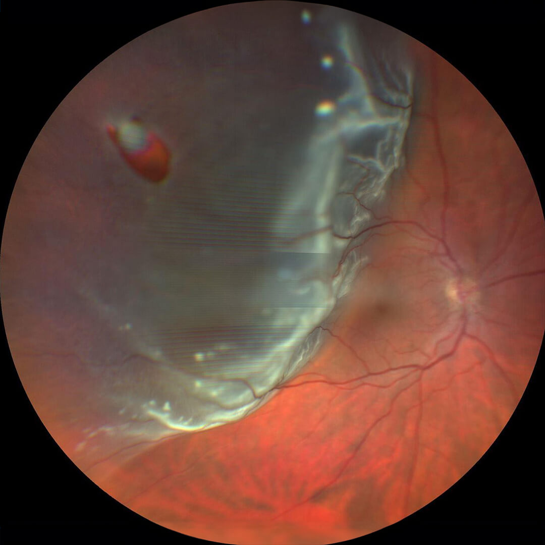 Scleral buckling do przyklejenia siatkówki Silikonowy pas bucklingu owinięty wokół gałki ocznej w operacji