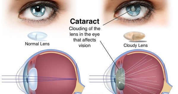 Okuliści diagnozują zaćmę u seniorów poprzez szczegółowe badanie przezierności soczewki oka